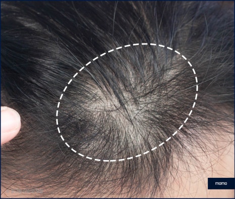정수리 탈모 모발이식 섬세하게 채워가는 관련 이미지 3