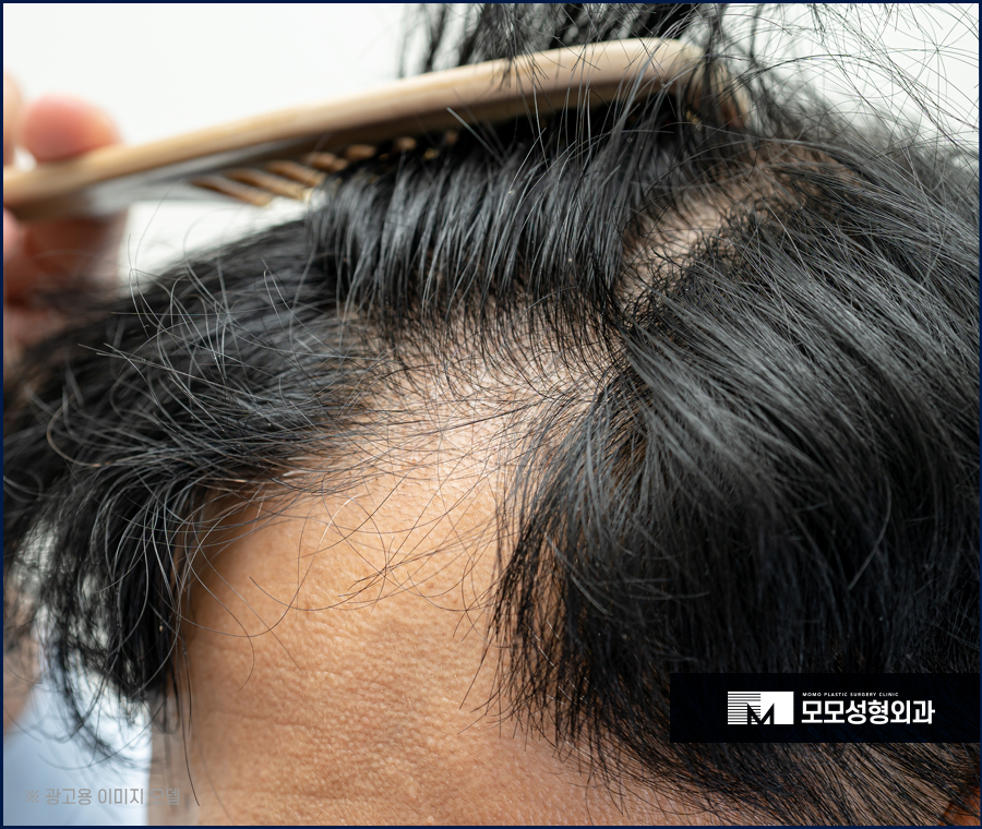 남자헤어라인교정 반듯함으로 완성하는 외모 관련 이미지 4