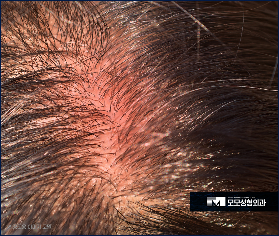 머리안감으면탈모 증상이 찾아올까요 진실은 관련 이미지 8