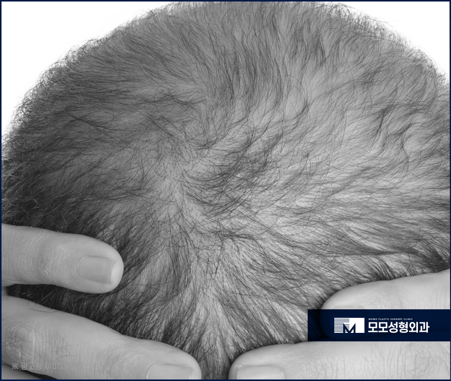 압구정 모발이식 안정적인 생착을 만드는 관련 이미지 8