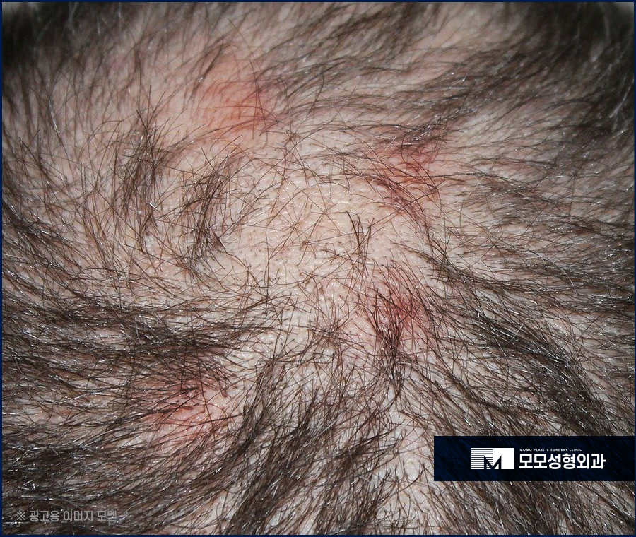 지루성두피염증상 어떤 것들이 있는지 관련 이미지 7