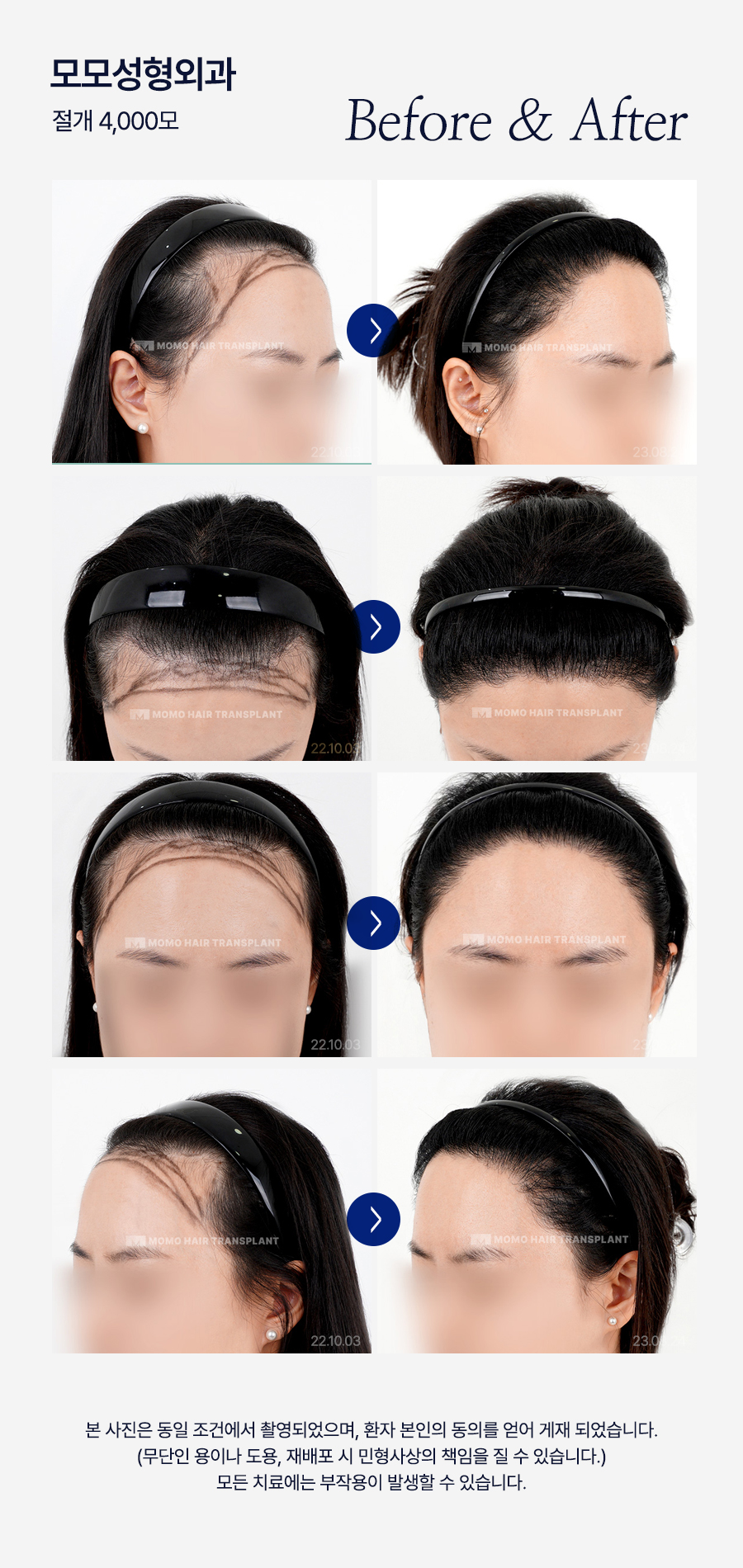 여자 측두부 탈모 아름다운 옆모습을 만드는 방법 관련 이미지 16