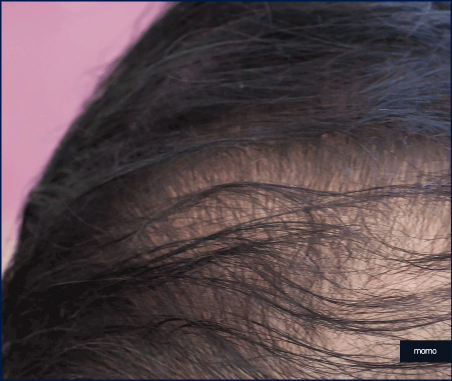 압구정 모발이식 세심한 사전 진단부터 시작하는 곳 관련 이미지 5