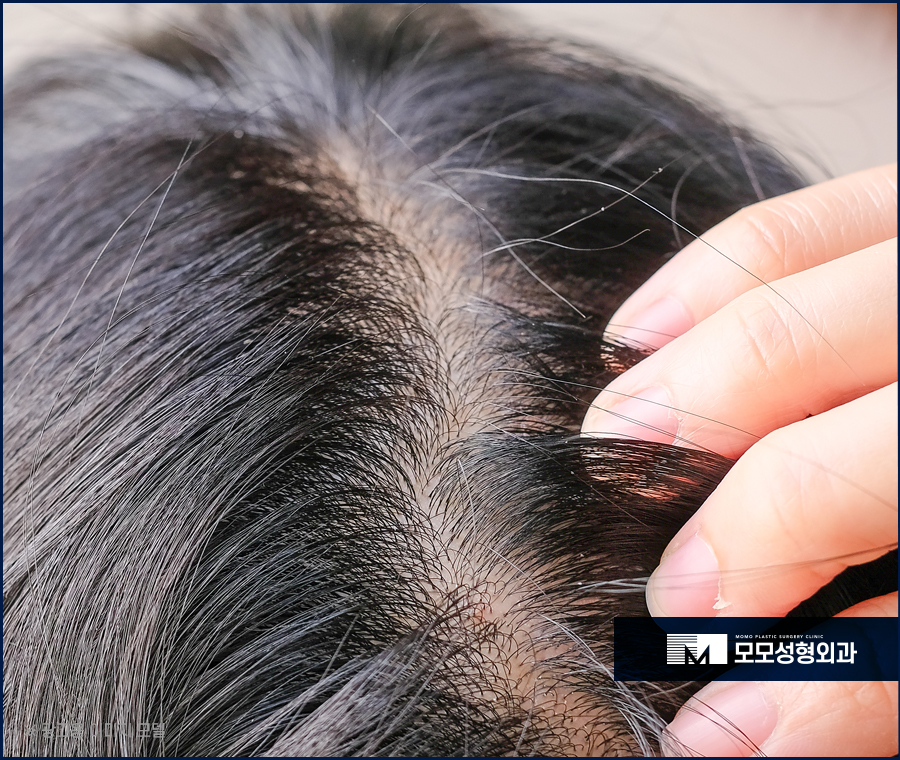 머리자주감으면 두피와 모발엔 어떤 영향이 미칠까 관련 이미지 6