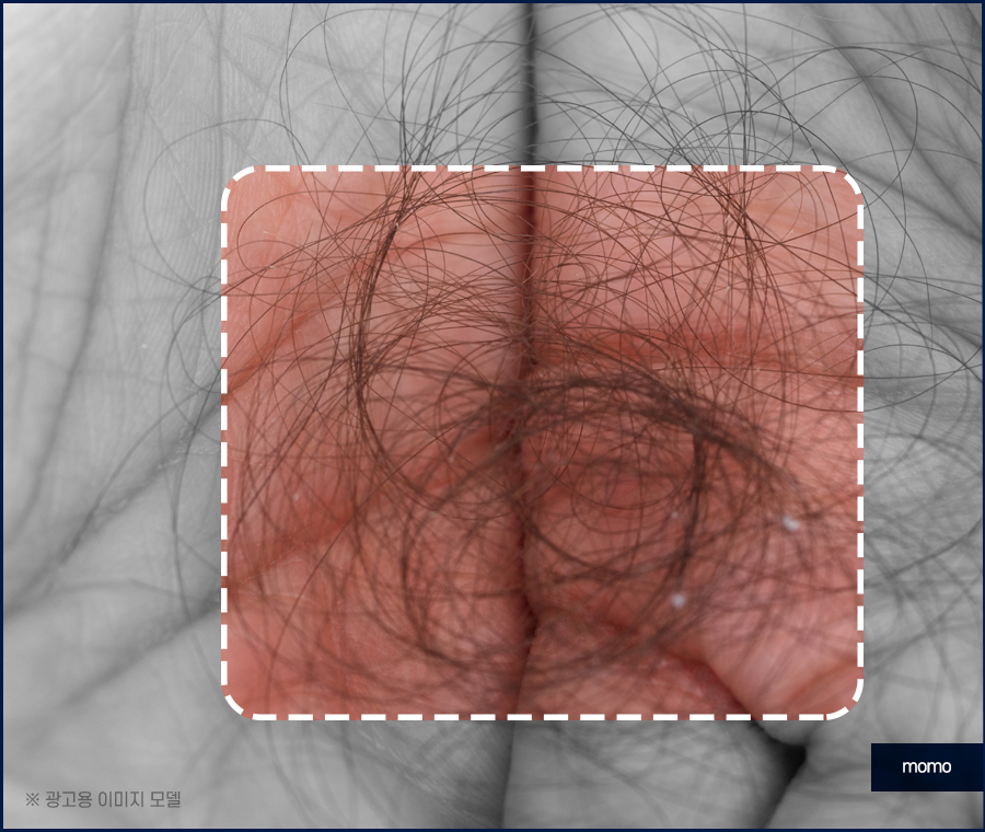 여성 모발이식 자연스러운 변화를 만드는 관련 이미지 9