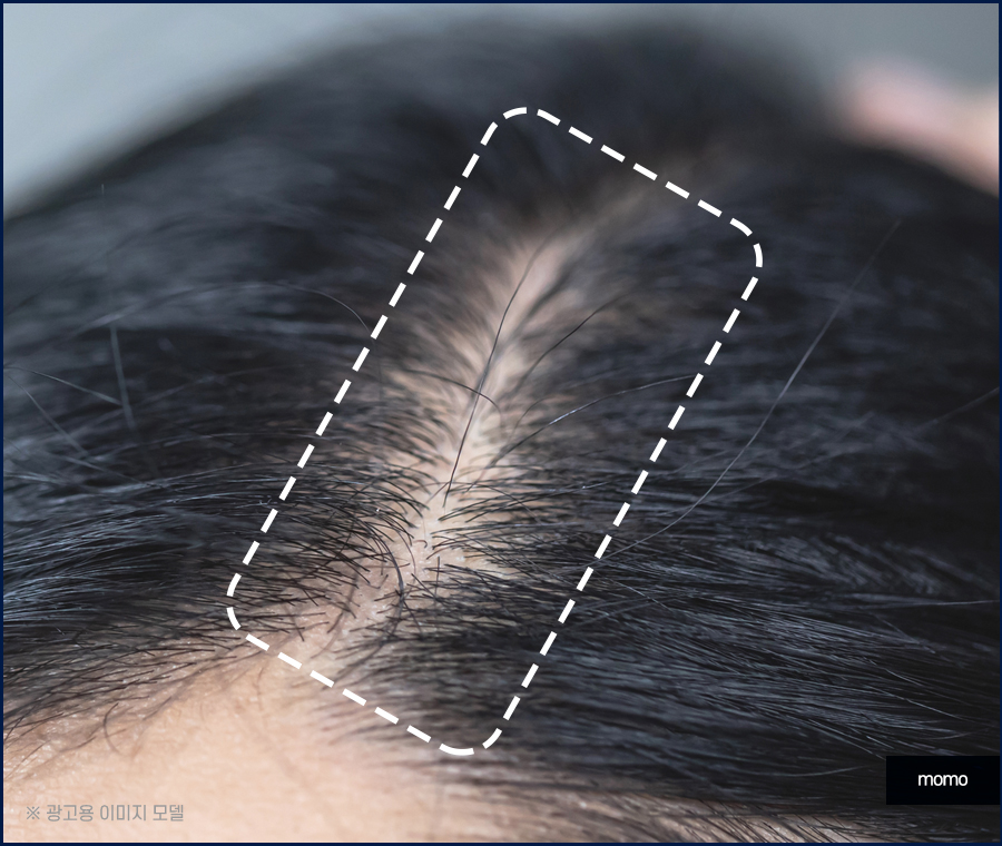 여자 정수리 탈모 모발이식 꼼꼼히 채우는 관련 이미지 9