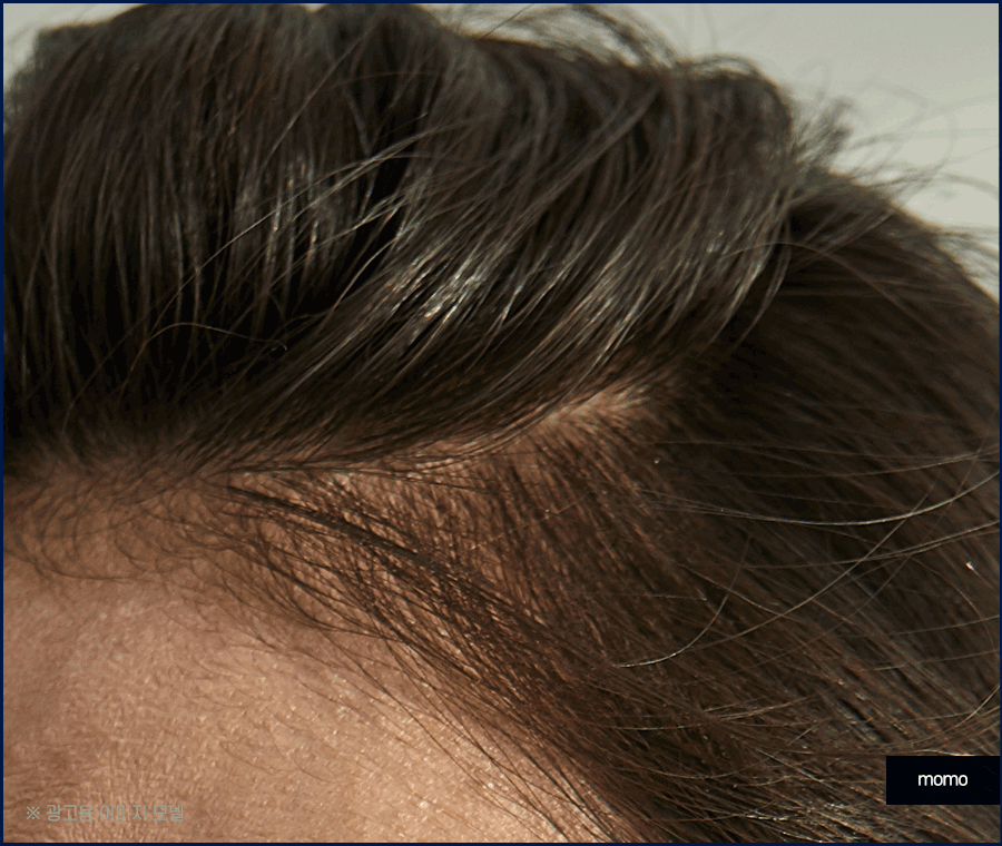 여자M자탈모 회복을 위한 맞춤 솔루션 관련 이미지 11