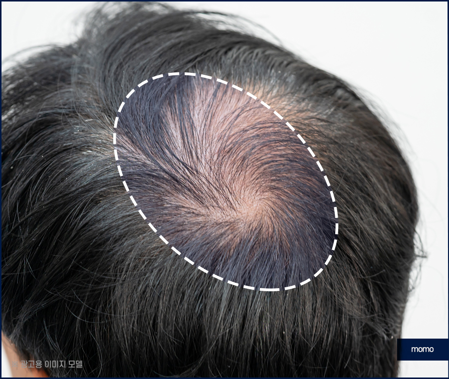 스트레스성 원형탈모를 유발하는 원인은 관련 이미지 6