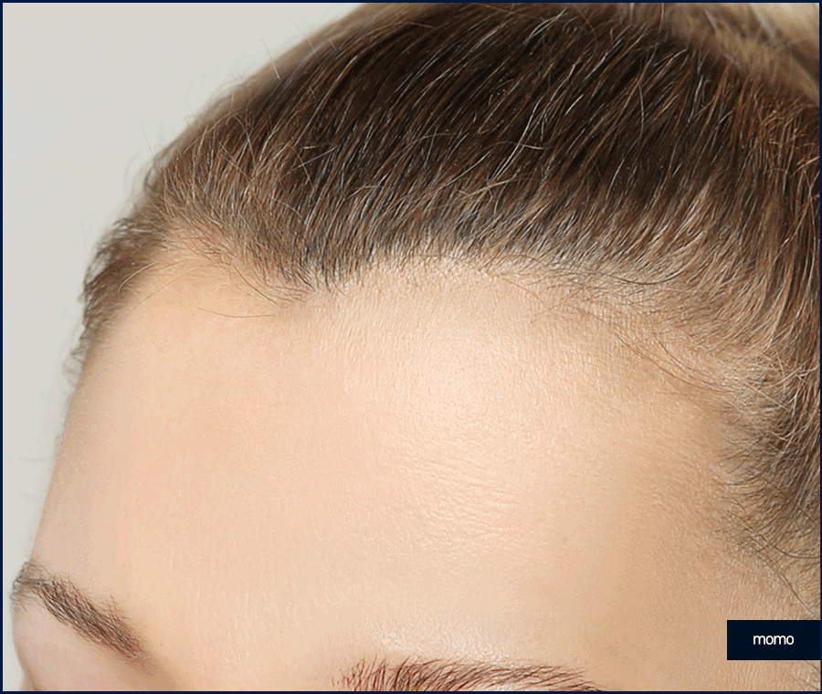 여자 모발이식 헤어라인 교정이 필요하다면 관련 이미지 6
