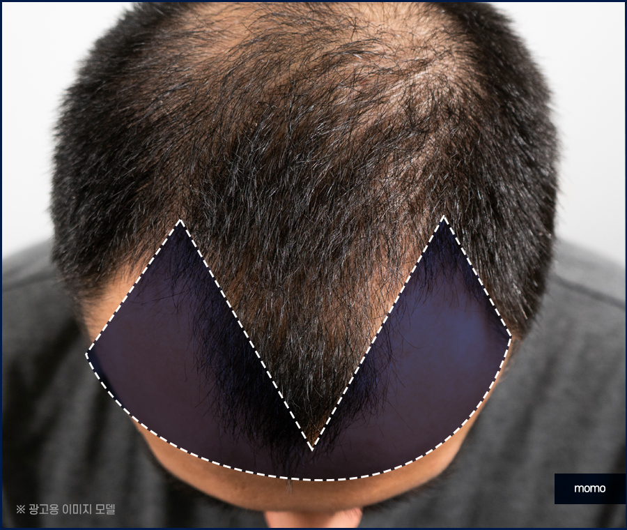 m자탈모초기 현상과 빠르게 대처하면 좋은 포인트는 관련 이미지 5