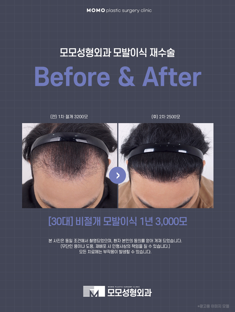 m자탈모모발이식 이미지 개선을 위한 선택 관련 이미지 5