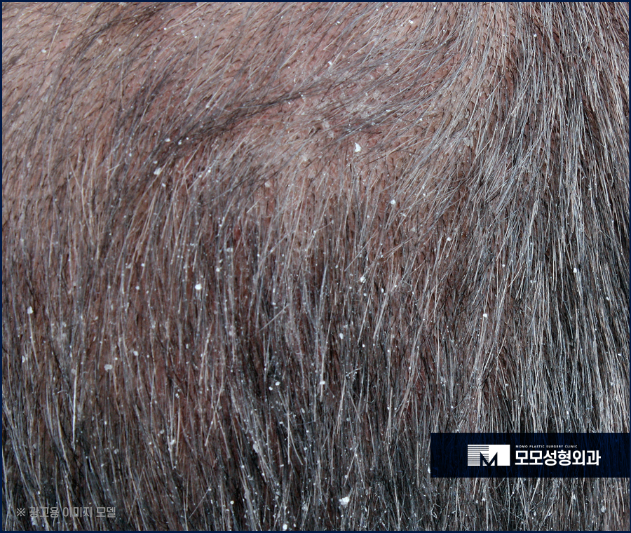 두피가려운이유 원인에 대해서 알아보는 관련 이미지 5