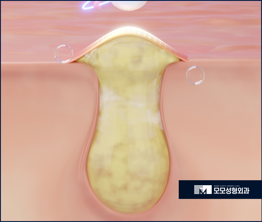 두피 피지낭종으로 인해 발생할 수 있는 문제들 관련 이미지 2