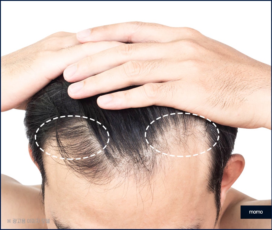 모발이식병원추천 선택 시 꼭 체크할 사항 3가지 관련 이미지 7