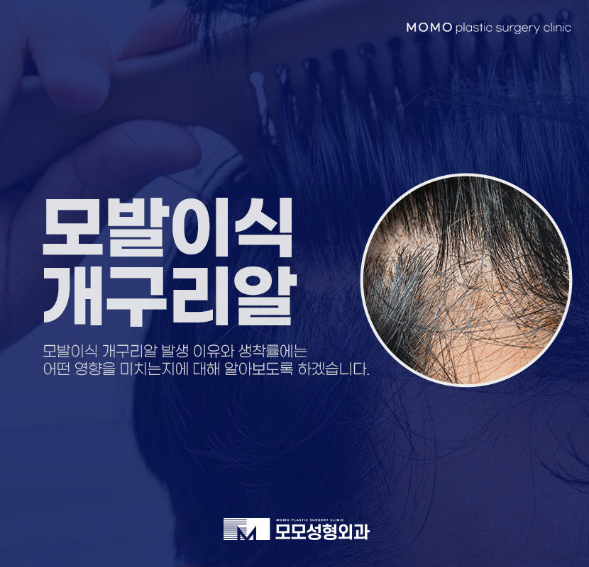 모발이식개구리알 발생 이유와 생착률과의 관계 관련 이미지 1