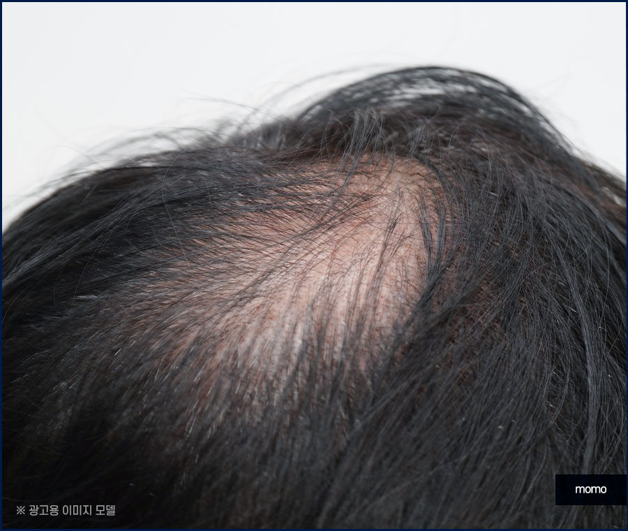 두피열 내리는 법 누구나 쉽게 할 수 있는 관련 이미지 3