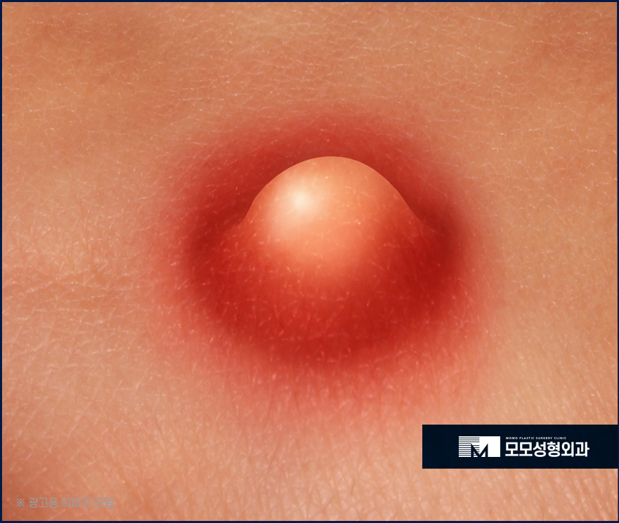 두피모낭염 증세와 해결 방법에 대해 관련 이미지 3