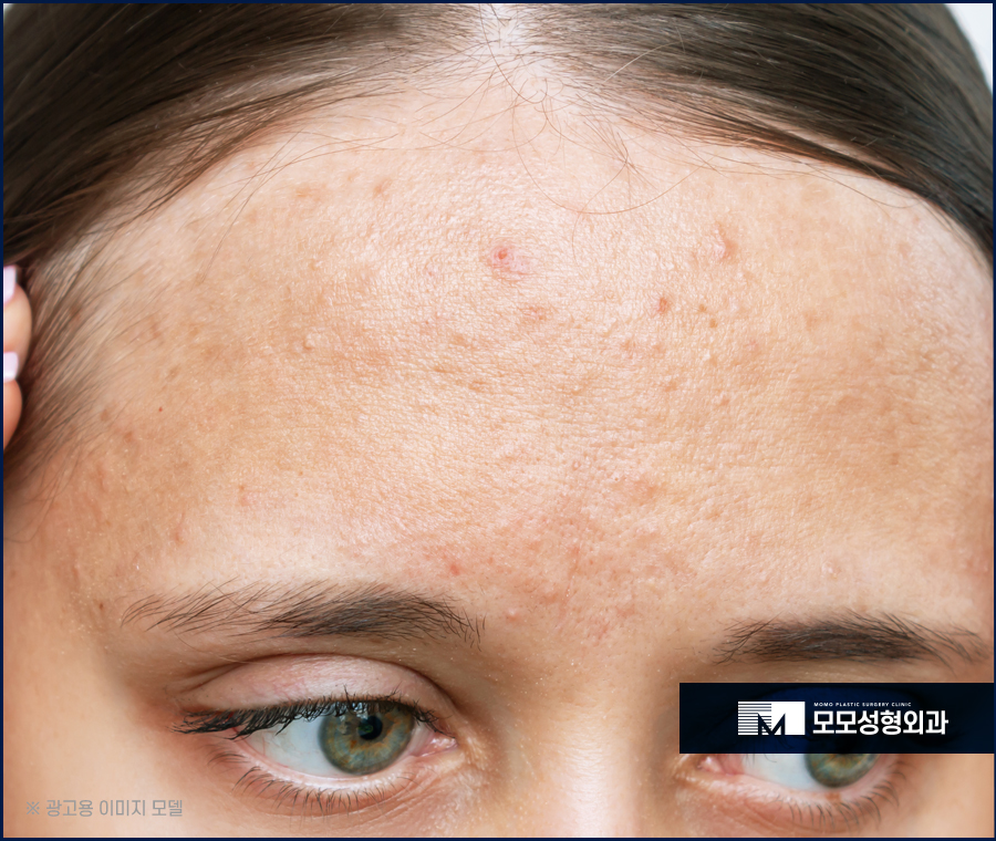 여자헤어라인교정 라인을 맞춰 아름다움을 높이는 관련 이미지 3