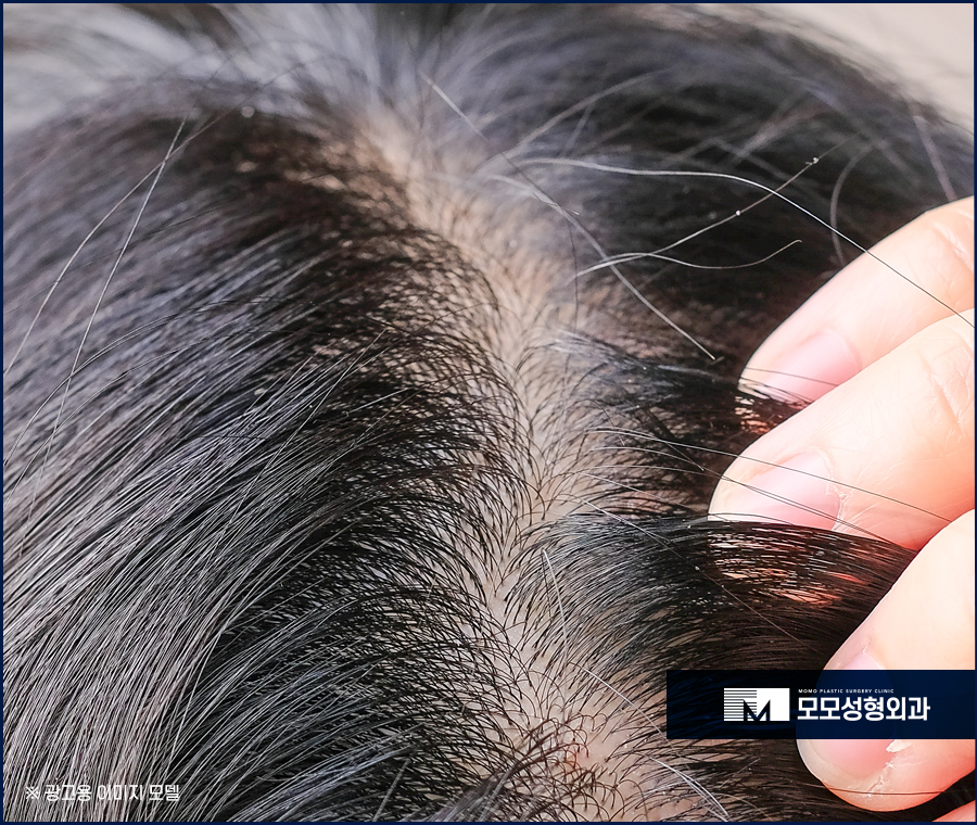 서울모발이식병원 한층 젊어질 수 있는 관련 이미지 2