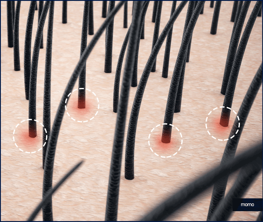 압구정모발이식 원하던 모습을 찾는 포인트 관련 이미지 8