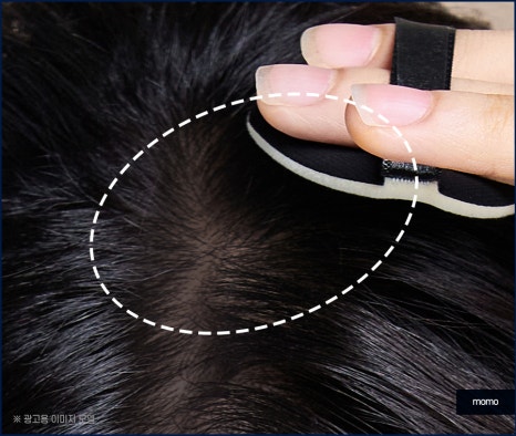 정수리 탈모 모발이식 섬세하게 채워가는 관련 이미지 4