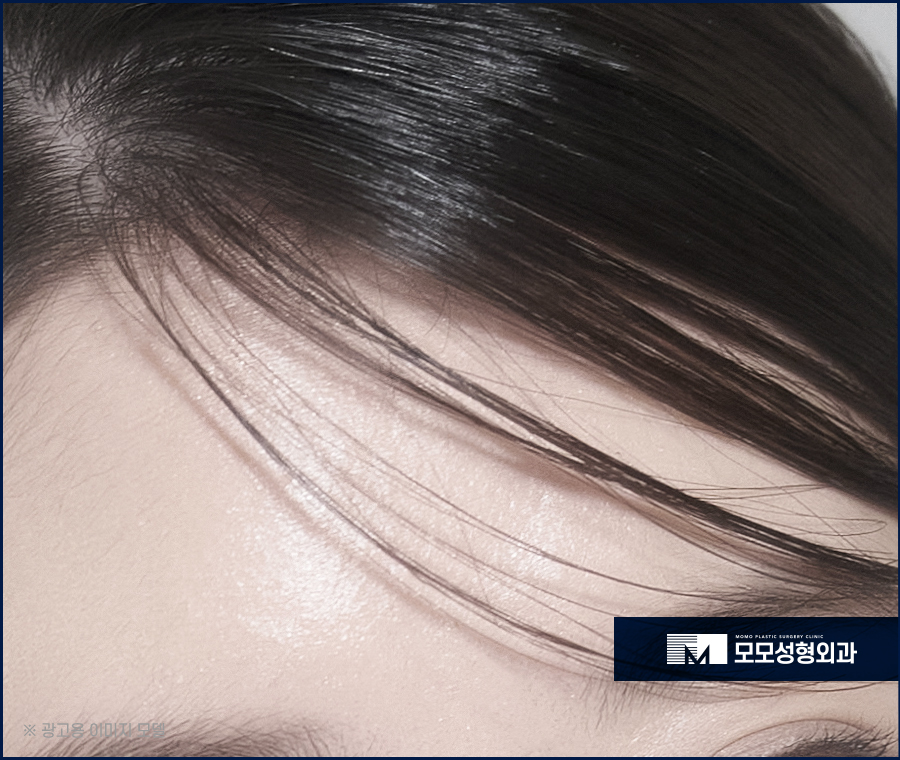 앞머리갈라짐 탈모 해결 방법까지 알아 보는 관련 이미지 2