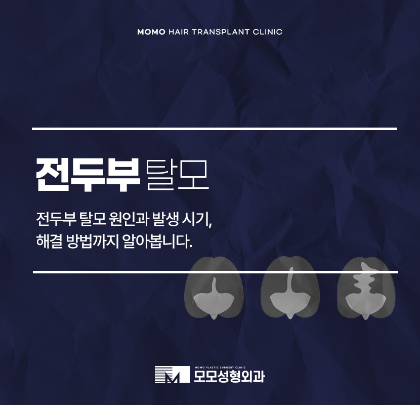 전두부탈모 원인과 시기, 해결 방안까지 관련 이미지 1