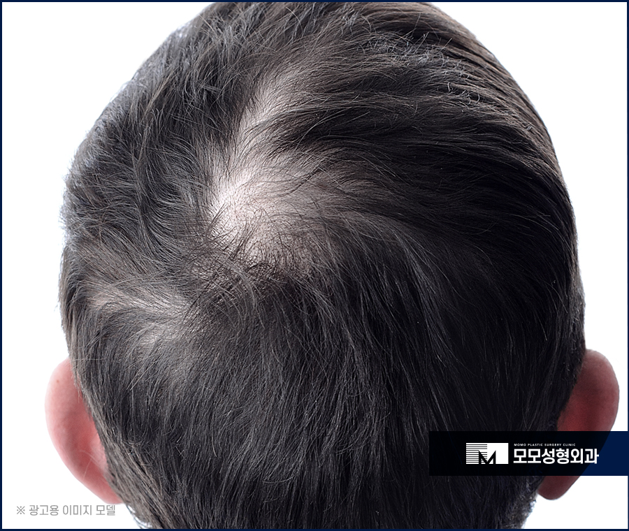 머리카락얇아짐 원인과 방치해선 안되는 이유 관련 이미지 2