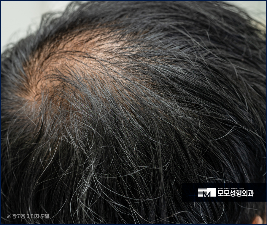 강남모발이식병원 탈모에 대한 고민을 나누는 곳 관련 이미지 4
