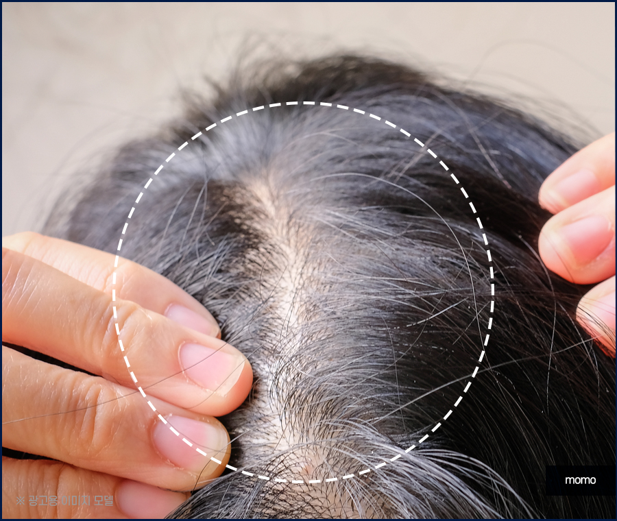 염색후 두피 가려움 원인과 완화 방법 관련 이미지 5