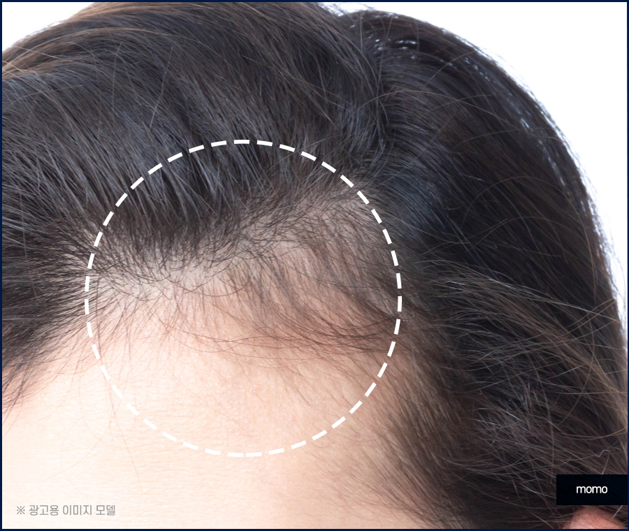 모발이식 후기 비교하며 섬세한 분석까지 해야만 관련 이미지 7