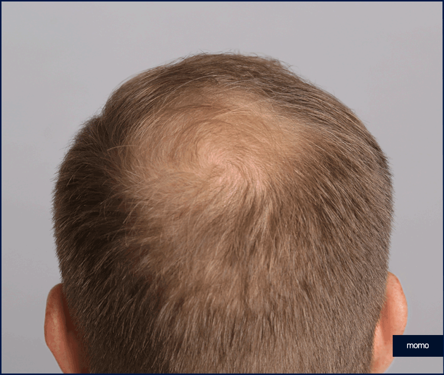 모발이식 금액 개인마다 차이가 나는 이유 관련 이미지 10