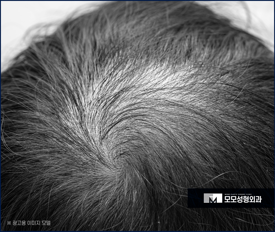 압구정모발이식 훌륭한 결과를 위해서는 관련 이미지 4