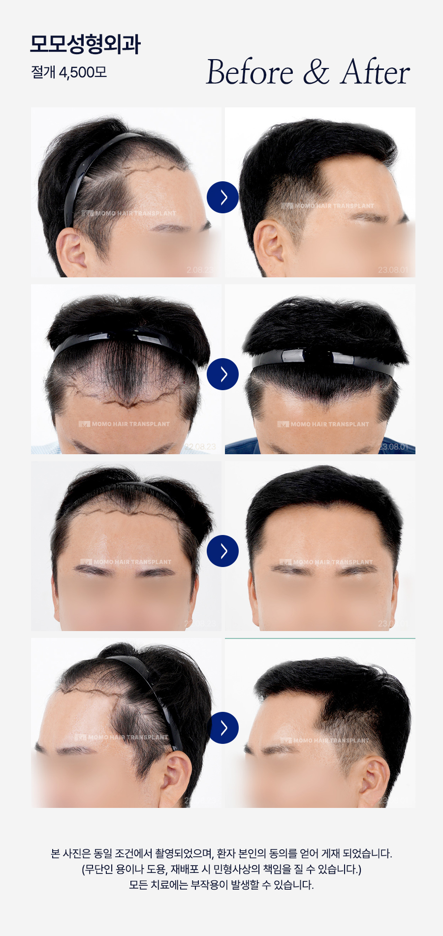 엠자탈모 약 진단과 처방으로 효과보기 위한 관련 이미지 15