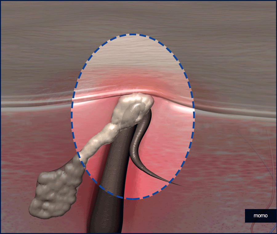 두피피딱지 원인 및 올바른 케어 방법은? 관련 이미지 9