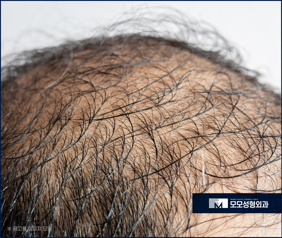 머리숱많아지는방법 효과를 기대하려면 관련 이미지 2