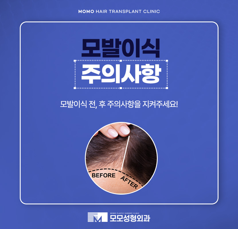 모발이식 주의사항과 꼼꼼히 숙지해야 하는 이유 관련 이미지 1
