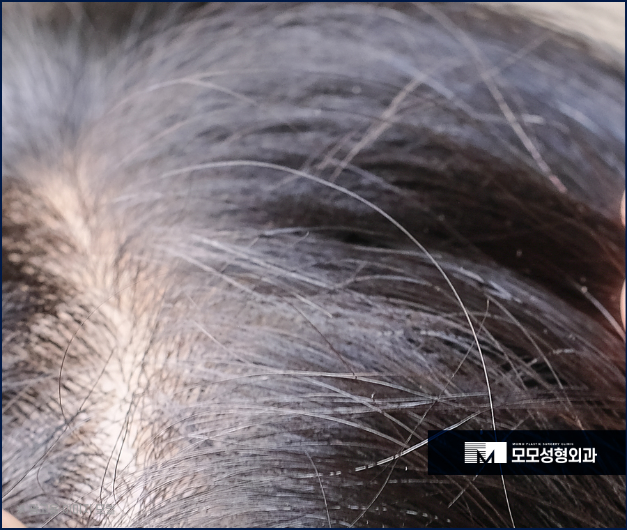 새치 뽑으면 생기는 문제 및 관리 방법까지 관련 이미지 2