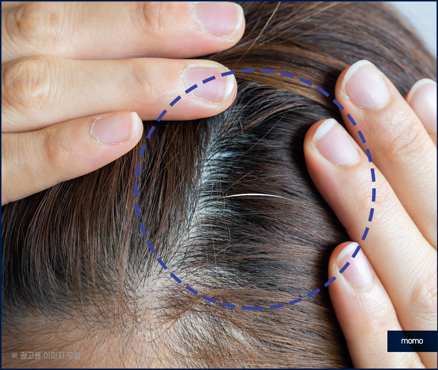 새치나는이유부터 뽑지 말아야 할 이유까지 관련 이미지 2