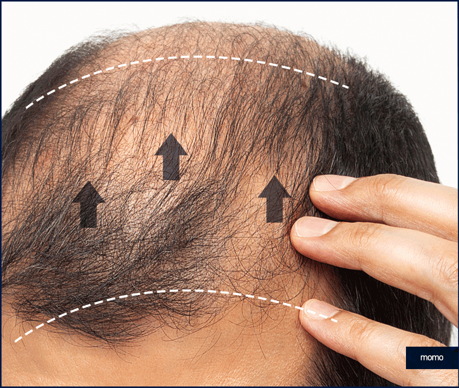 남자헤어라인모발이식 디자인의 중요성 관련 이미지 9