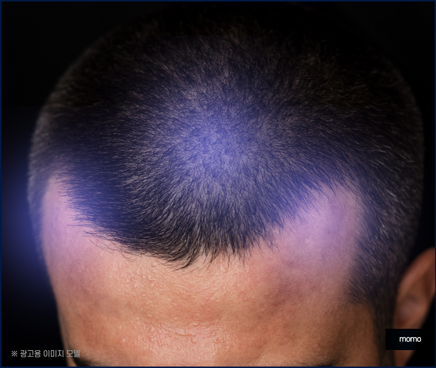 절개모발이식 차이점을 알고 정해야만 관련 이미지 11