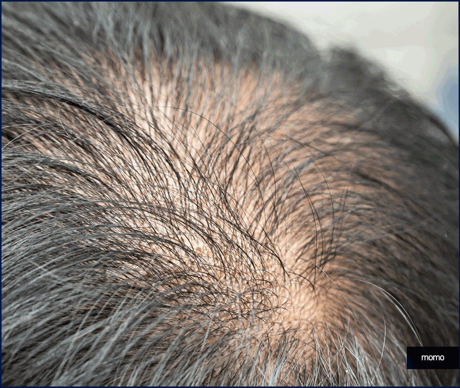 압구정 모발이식 세심한 사전 진단부터 시작하는 곳 관련 이미지 9