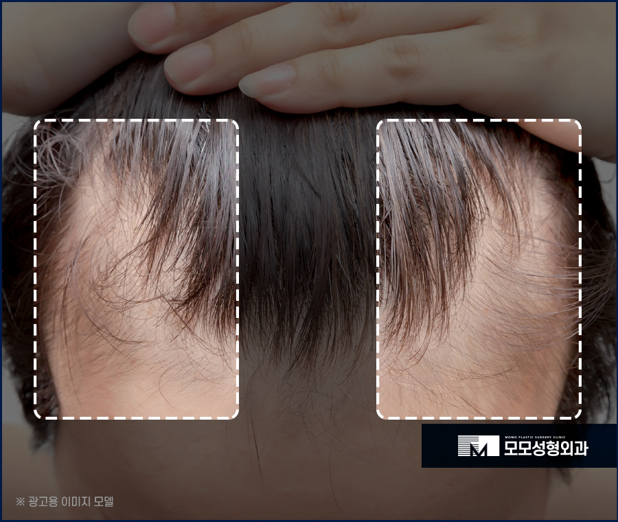 M자 모발이식 비용과 금액대가 달라지는 이유 관련 이미지 7