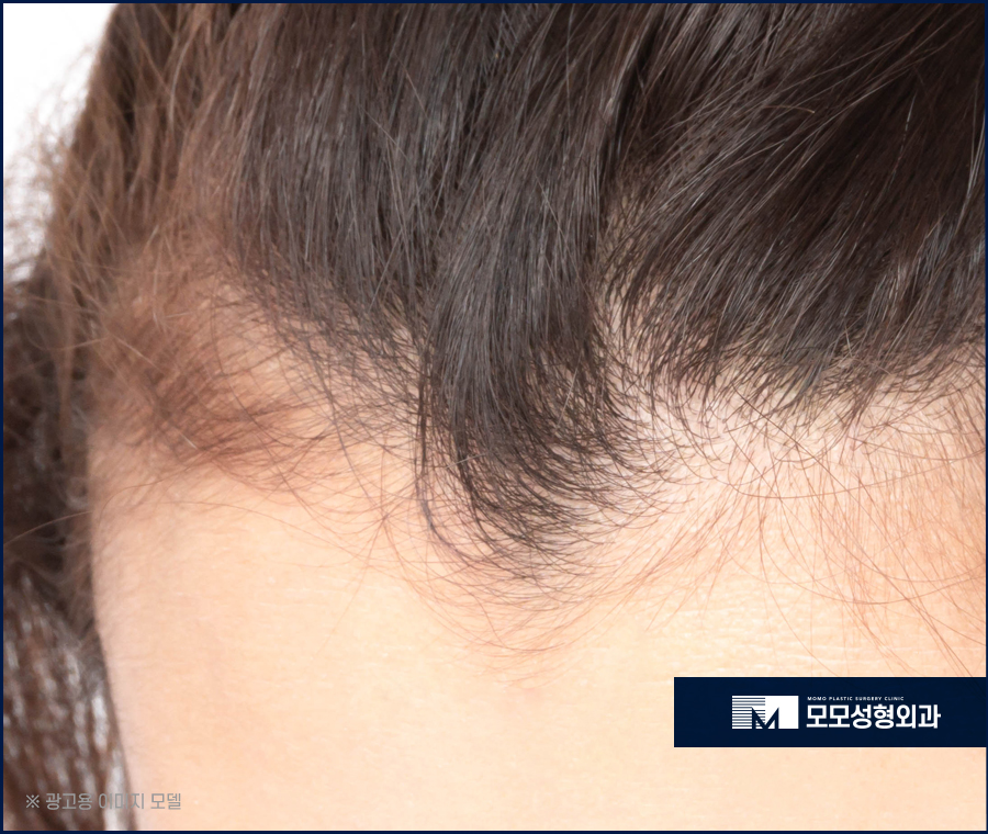 남자헤어라인모발이식 디자인까지 꼼꼼하게 고려하며 관련 이미지 3