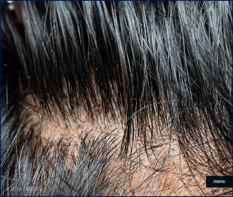 모발이식 2000모 자연스러운 커버 결과 정도는? 관련 이미지 6