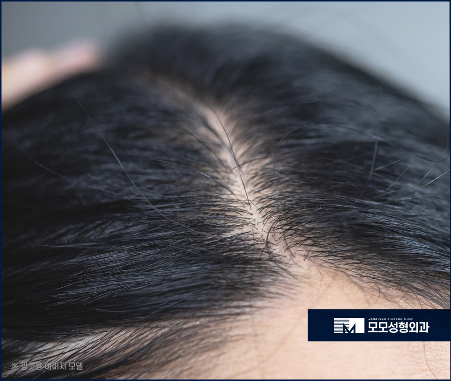 연모화 증상 원인과 방치에 대한 위험성까지 관련 이미지 6