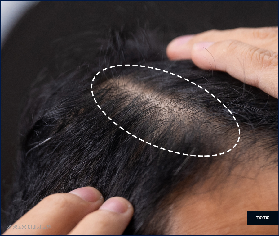 모발이식잘하는곳 찾는 결정적인 기준 관련 이미지 6