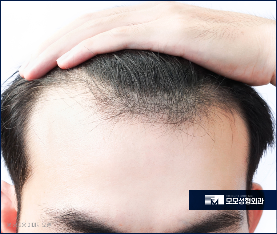 M자탈모약 효과적인 예후를 이뤄가는 관련 이미지 4
