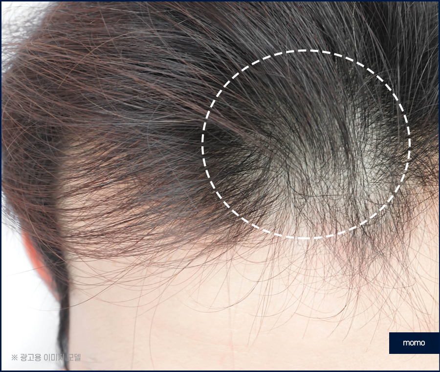 M자모발이식비용 가격 탈모 탈출을 위한 관련 이미지 8