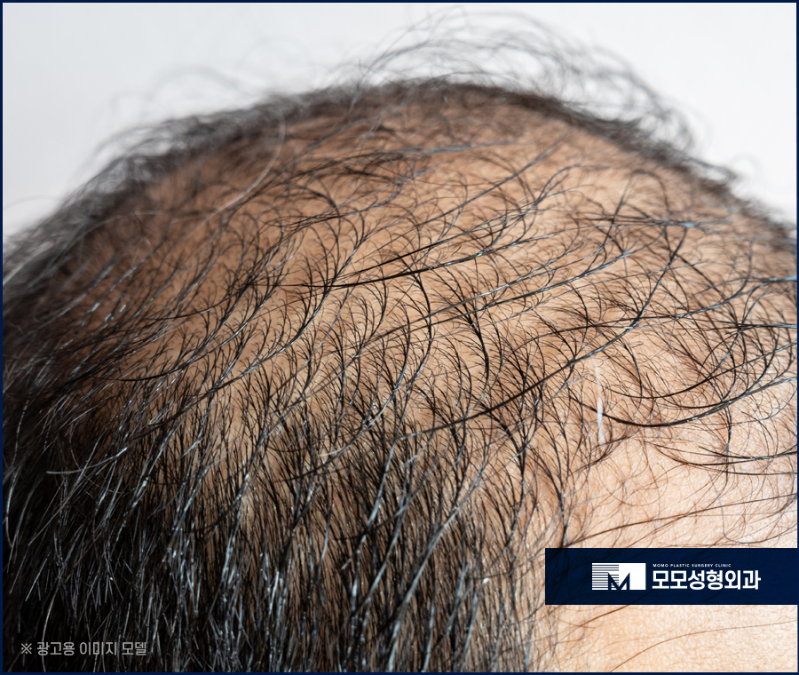 압구정탈모병원 체계적인 진단으로 관련 이미지 2